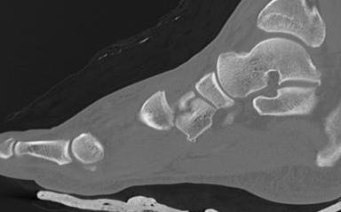 Lis Franc Dorsal Displacement